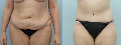Body Lift Before & After Gallery - Patient 49149636 - Image 1
