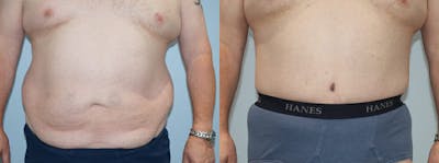 Body Lift Before & After Gallery - Patient 49149640 - Image 1