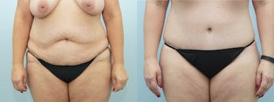 Body Lift Before & After Gallery - Patient 49149642 - Image 1