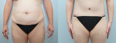Body Lift Before & After Gallery - Patient 49149647 - Image 1