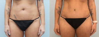 Tummy Tuck Before & After Gallery - Patient 49149763 - Image 1