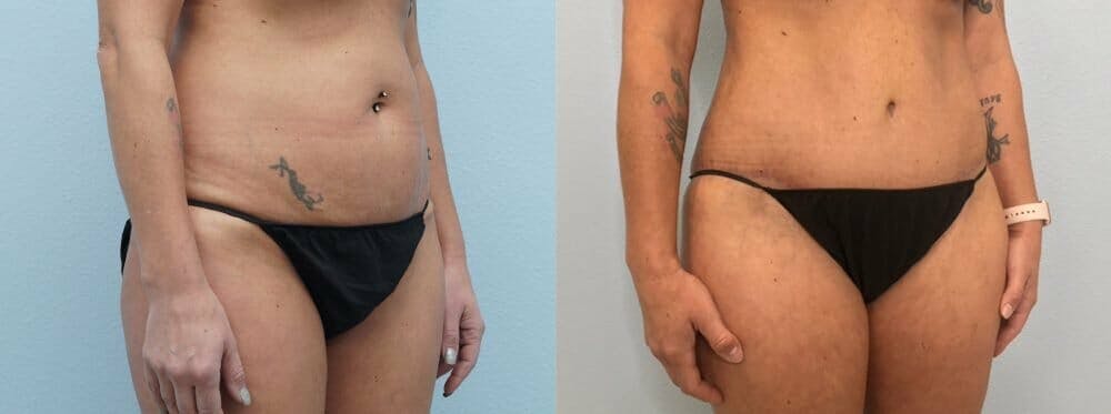 Tummy Tuck Gallery - Patient 49149763 - Image 5