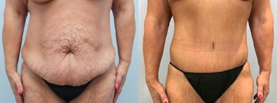 Tummy Tuck Before & After Gallery - Patient 49149764 - Image 1