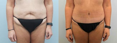 Tummy Tuck Before & After Gallery - Patient 49149770 - Image 1