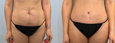 Tummy Tuck Before & After Gallery - Patient 49149774 - Image 1