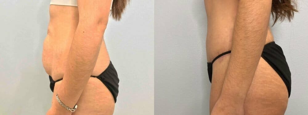 Tummy Tuck Gallery - Patient 49149774 - Image 3