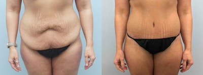 Tummy Tuck Before & After Gallery - Patient 49149777 - Image 1
