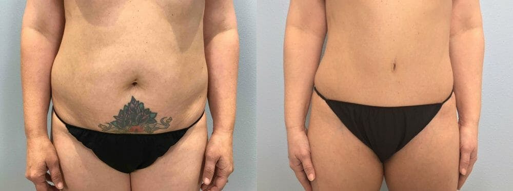Tummy Tuck