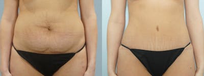Tummy Tuck Before & After Gallery - Patient 49149784 - Image 1