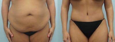 Tummy Tuck Before & After Gallery - Patient 49149787 - Image 1