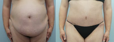 Tummy Tuck Before & After Gallery - Patient 49149790 - Image 1