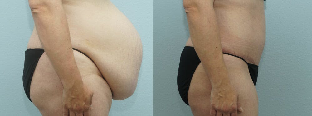 Tummy Tuck Gallery - Patient 49149790 - Image 3