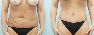 Tummy Tuck Before & After Gallery - Patient 49149792 - Image 1