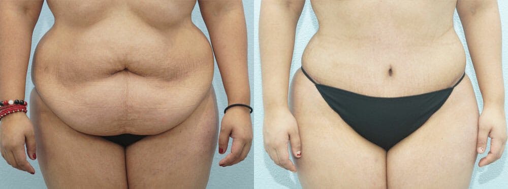 Tummy Tuck Gallery - Patient 49149797 - Image 1