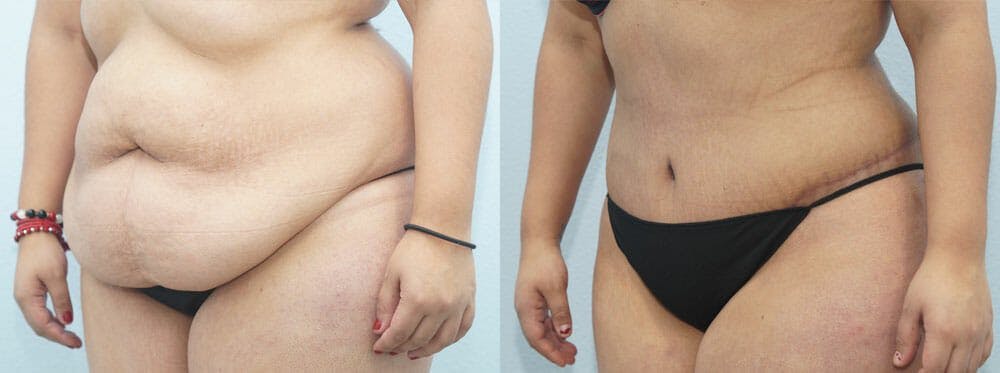 Tummy Tuck Gallery - Patient 49149797 - Image 3
