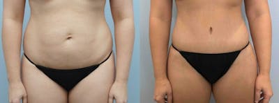 Tummy Tuck Before & After Gallery - Patient 49149798 - Image 1