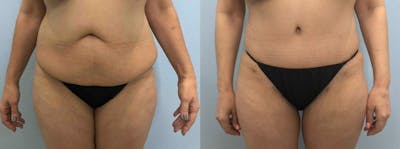 Tummy Tuck Before & After Gallery - Patient 49149804 - Image 1