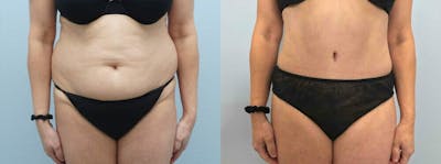 Tummy Tuck Before & After Gallery - Patient 49149808 - Image 1