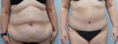 Tummy Tuck Before & After Gallery - Patient 49149862 - Image 1