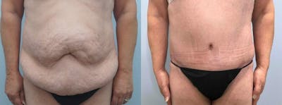 Tummy Tuck Before & After Gallery - Patient 49149863 - Image 1