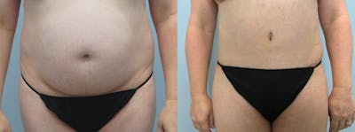 Tummy Tuck Before & After Gallery - Patient 49149871 - Image 1