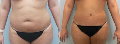 Tummy Tuck Before & After Gallery - Patient 49149874 - Image 1