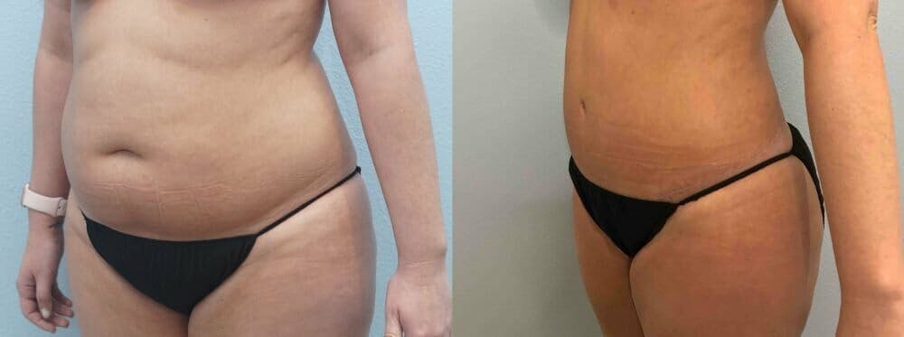 Tummy Tuck Gallery - Patient 49149874 - Image 3