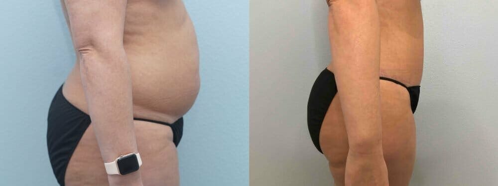 Tummy Tuck Gallery - Patient 49149874 - Image 6
