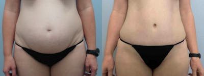 Tummy Tuck Before & After Gallery - Patient 49149928 - Image 1