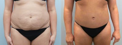 Tummy Tuck Before & After Gallery - Patient 49149930 - Image 1