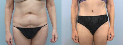 Tummy Tuck Before & After Gallery - Patient 49149934 - Image 1