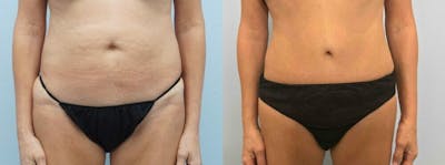 Tummy Tuck Before & After Gallery - Patient 49149938 - Image 1