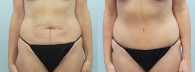 Tummy Tuck Before & After Gallery - Patient 49149995 - Image 1