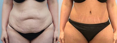 Tummy Tuck Before & After Gallery - Patient 49149996 - Image 1