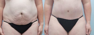 Tummy Tuck Before & After Gallery - Patient 49150054 - Image 1