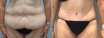 Tummy Tuck Before & After Gallery - Patient 49150082 - Image 1