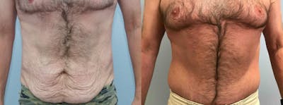 Tummy Tuck Before & After Gallery - Patient 49150086 - Image 1