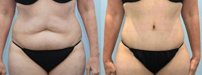 Tummy Tuck Before & After Gallery - Patient 49150087 - Image 1