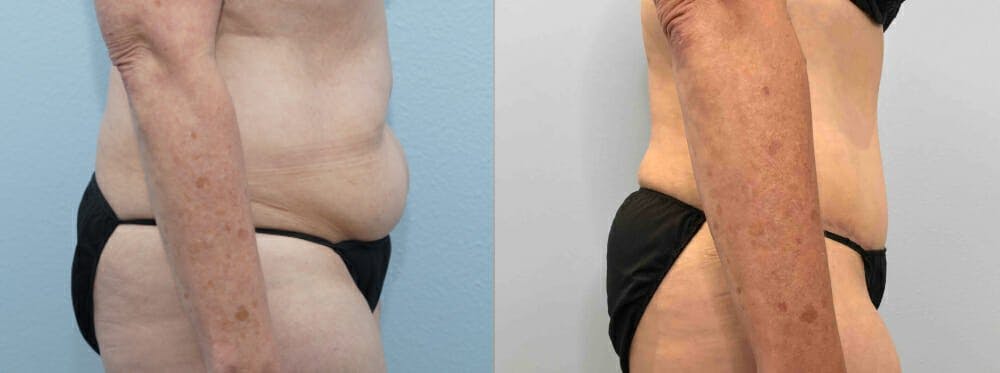 Tummy Tuck Gallery - Patient 49150087 - Image 5