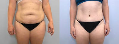 Tummy Tuck Before & After Gallery - Patient 49150088 - Image 1
