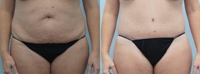 Tummy Tuck Before & After Gallery - Patient 49150093 - Image 1