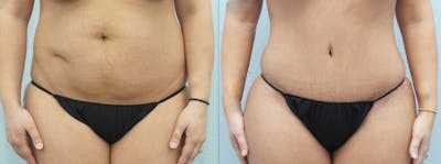 Tummy Tuck Before & After Gallery - Patient 49150762 - Image 1