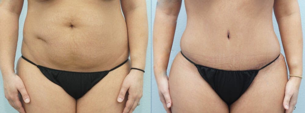 Tummy Tuck Gallery - Patient 49150762 - Image 1