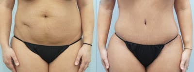 Tummy Tuck Before & After Gallery - Patient 49150762 - Image 1