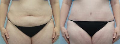 Tummy Tuck Before & After Gallery - Patient 49150765 - Image 1