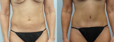 Tummy Tuck Before & After Gallery - Patient 49150766 - Image 1