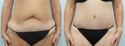 Tummy Tuck Before & After Gallery - Patient 49150771 - Image 1