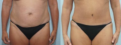 Tummy Tuck Before & After Gallery - Patient 49150776 - Image 1