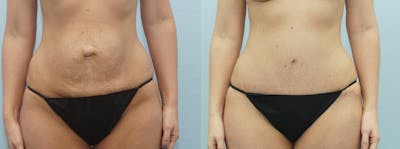 Tummy Tuck Before & After Gallery - Patient 49150782 - Image 1