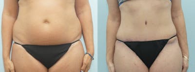 Tummy Tuck Before & After Gallery - Patient 49150784 - Image 1